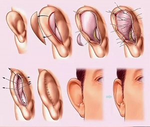 Пластическая операция на ушах: как выглядит процедура?